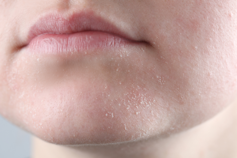 Kdaj je suha koža lahko znak težav?