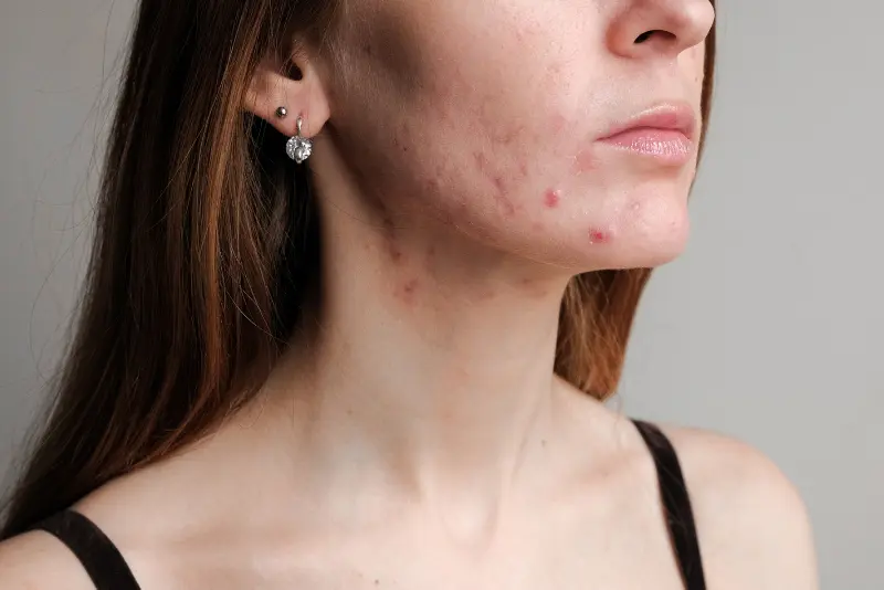 Akne, mozolji ali samo ogrci? Kaj se dogaja z vašo kožo?