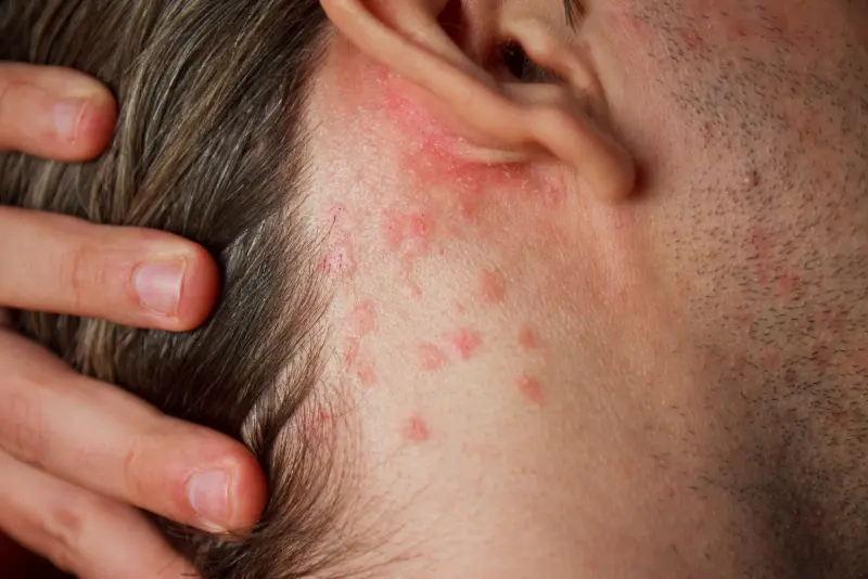 Je luskavica (psoriaza) na obrazu obvladljiva? Kako jo umiriti?