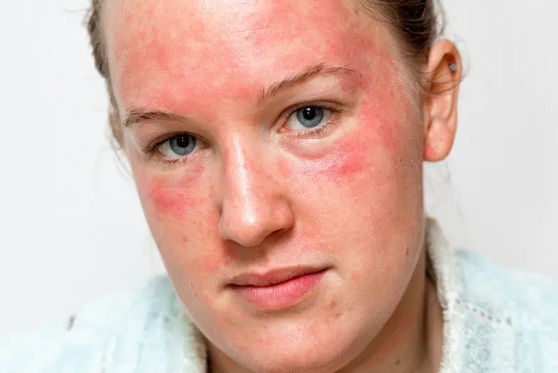Je pekoča koža na obrazu po nanosu izdelkov normalen odziv?